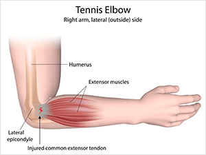 physio-tennis-elbow