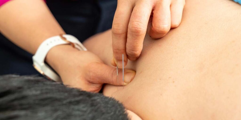 Dry Needling in action, led by our experienced physiotherapists at In Touch Physiotherapy Clinic Singapore